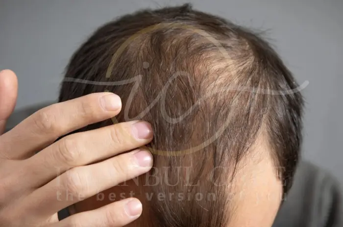 o-mounjaro-causa-perda-de-cabelo