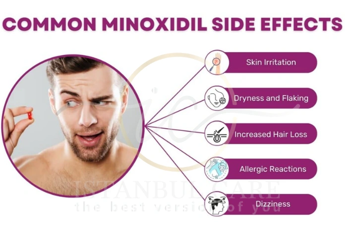minoxidil for hair loss minoxidil for hair loss