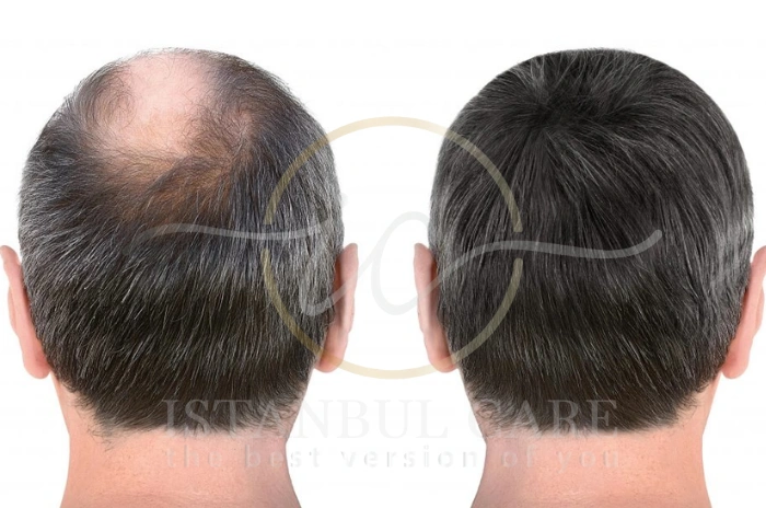minoxidil side effects minoxidil side effects
