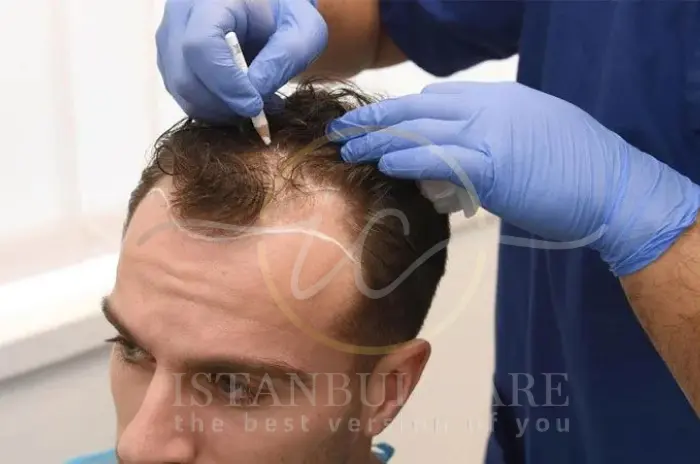 stem cell hair treatments