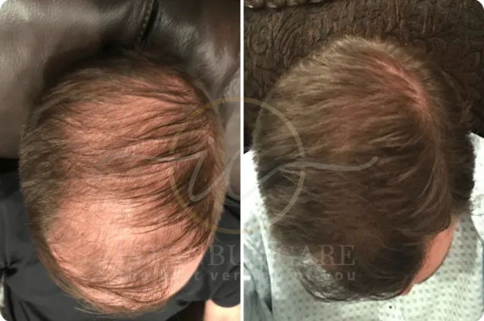 telogen effluvium regrowth (1) telogen effluvium regrowth