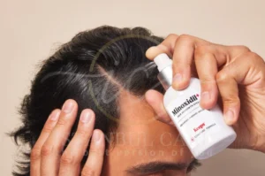 Minoxidil for hair loss