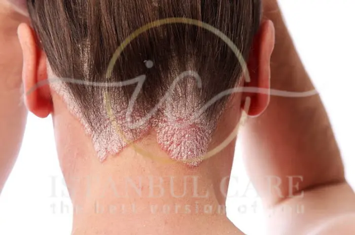 What is Tinea Capitis Causes, Symptoms, and Treatment