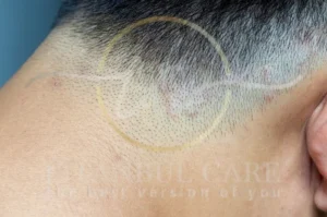 What is Tinea Capitis Causes and Symptoms