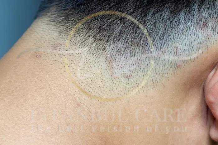 What is Tinea Capitis Causes and Symptoms