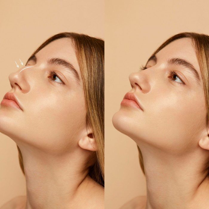 woman-getting-ready-nose-job-surgery (2) rhinoplasty Istanbul