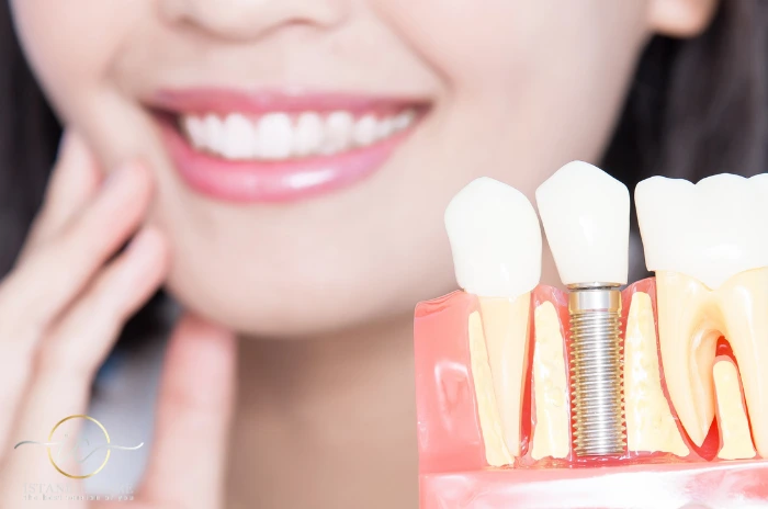Healing Process After Dental Implants